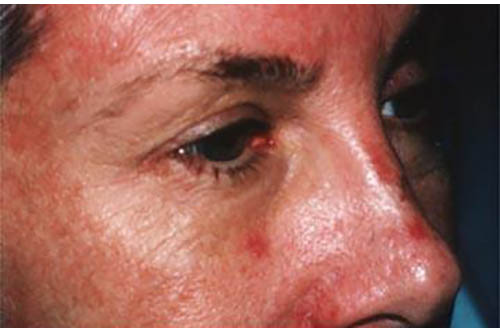 Blepharoplasty before photo