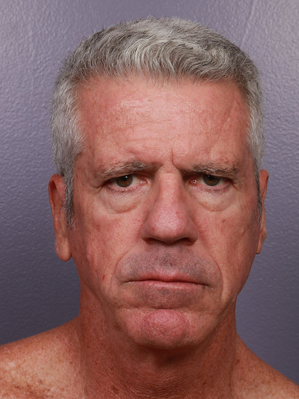 Neck Lift before photo