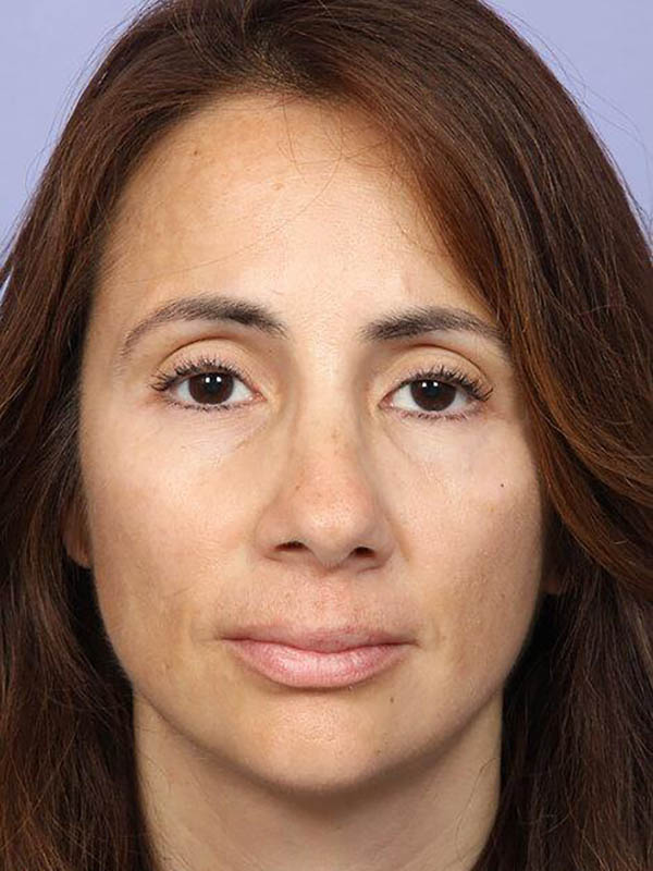 Rhinoplasty result at Marina Plastic Surgery