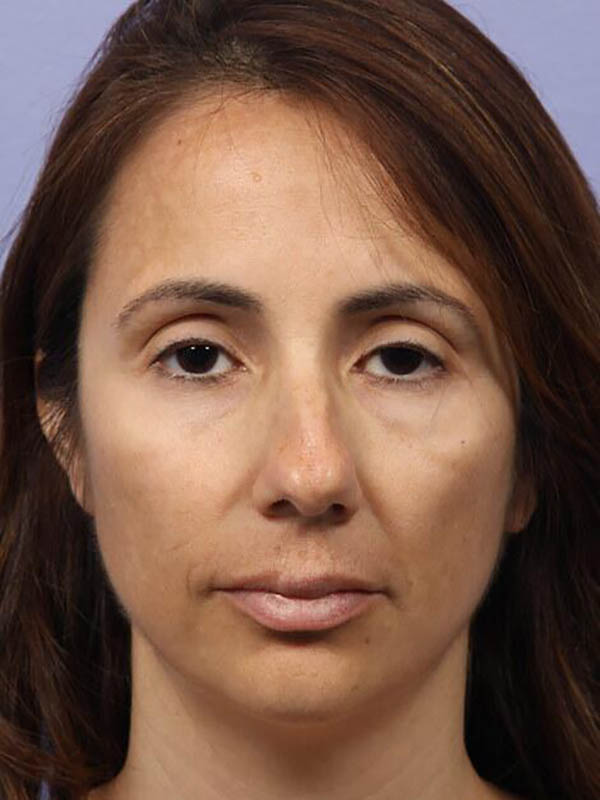 Rhinoplasty before photo