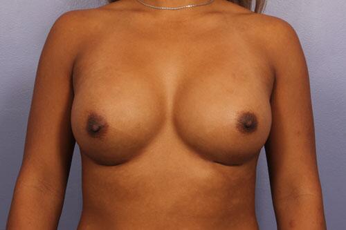 Breast Augmentation result at Marina Plastic Surgery