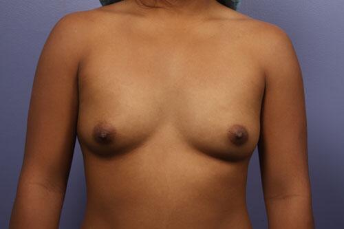 Breast Augmentation before photo
