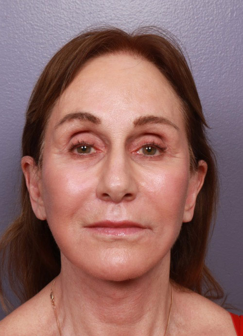 Neck Lift result at Marina Plastic Surgery