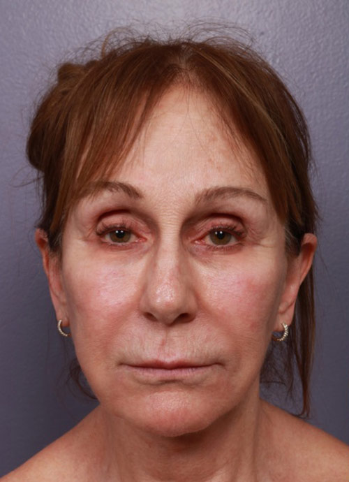 Neck Lift before photo