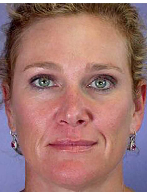 Blepharoplasty result at Marina Plastic Surgery