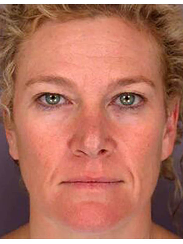 Blepharoplasty before photo