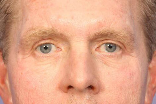 Blepharoplasty result at Marina Plastic Surgery