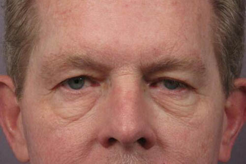 Blepharoplasty before photo