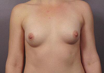 Breast Augmentation before photo