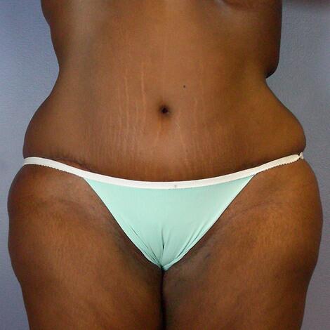 Tummy Tuck result at Marina Plastic Surgery