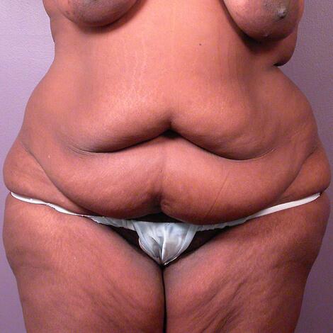 Tummy Tuck before photo