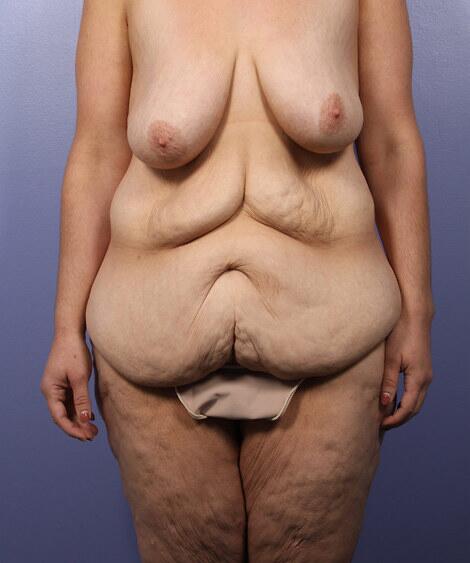 Tummy Tuck before photo