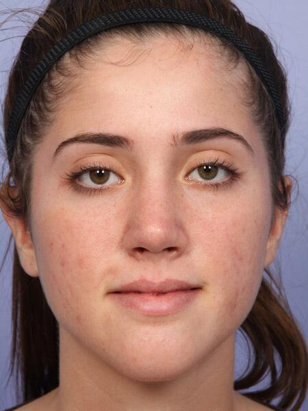 Rhinoplasty result at Marina Plastic Surgery