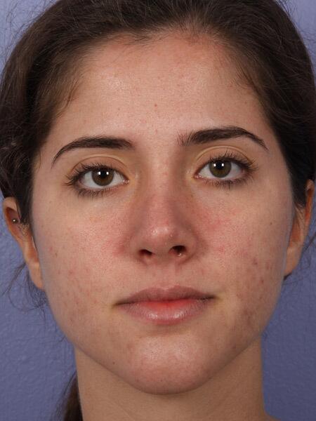 Rhinoplasty before photo
