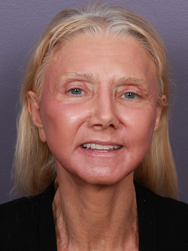 Neck Lift result at Marina Plastic Surgery