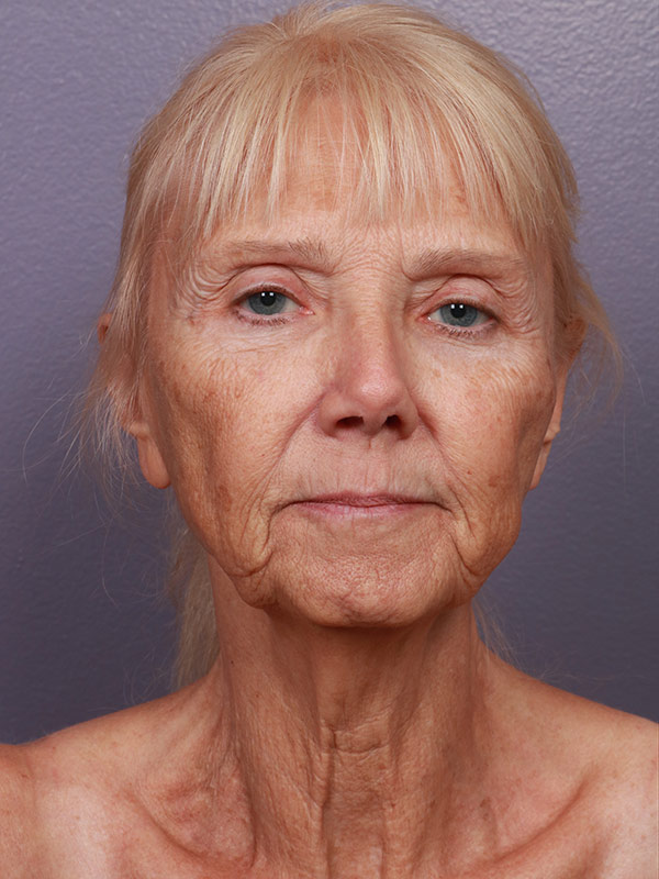Neck Lift before photo