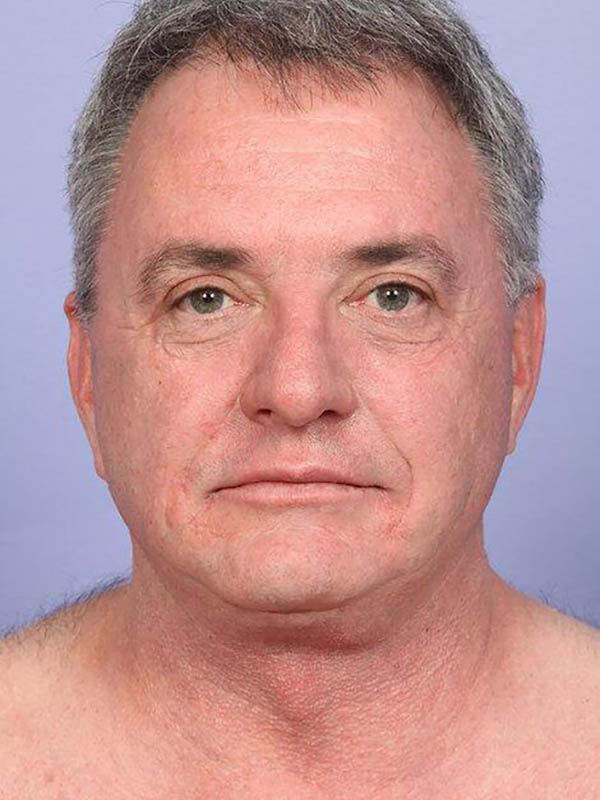 Facelift result at Marina Plastic Surgery