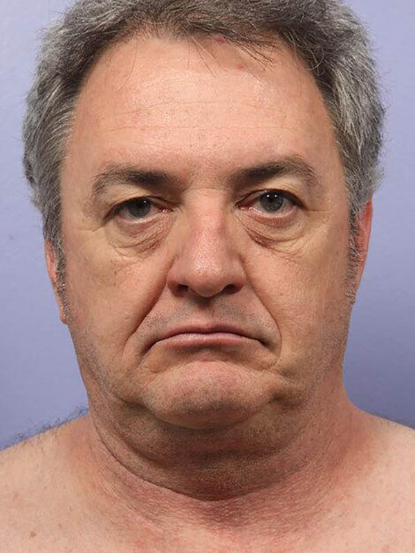 Facelift before photo