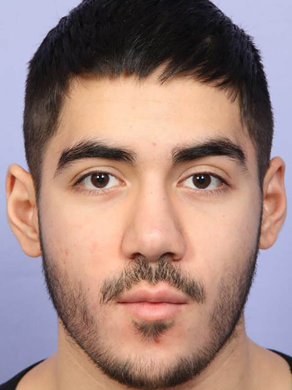 Rhinoplasty result at Marina Plastic Surgery