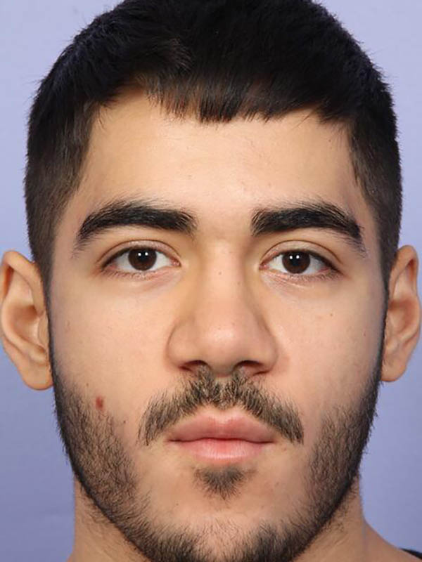 Rhinoplasty before photo
