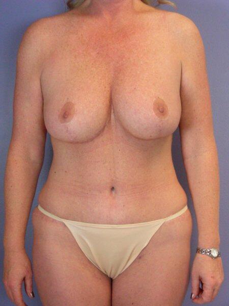 Mommy Makeover result at Marina Plastic Surgery