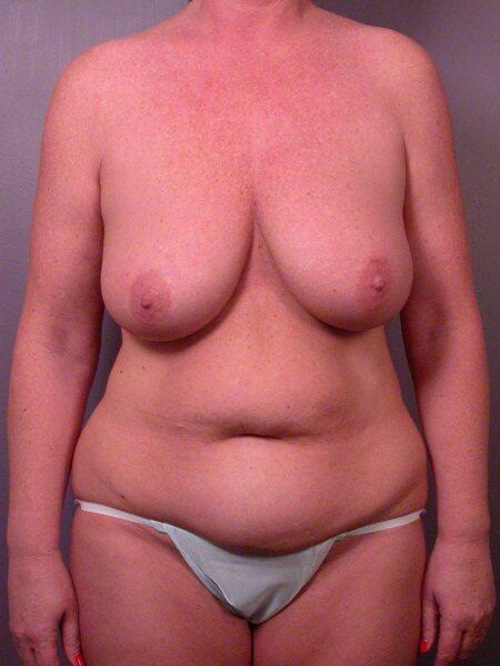 Mommy Makeover before photo