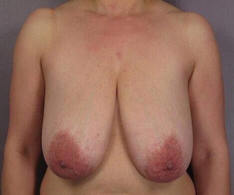 Breast Lift before photo