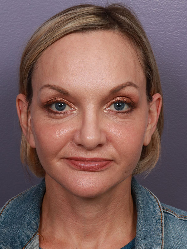 Neck Lift result at Marina Plastic Surgery