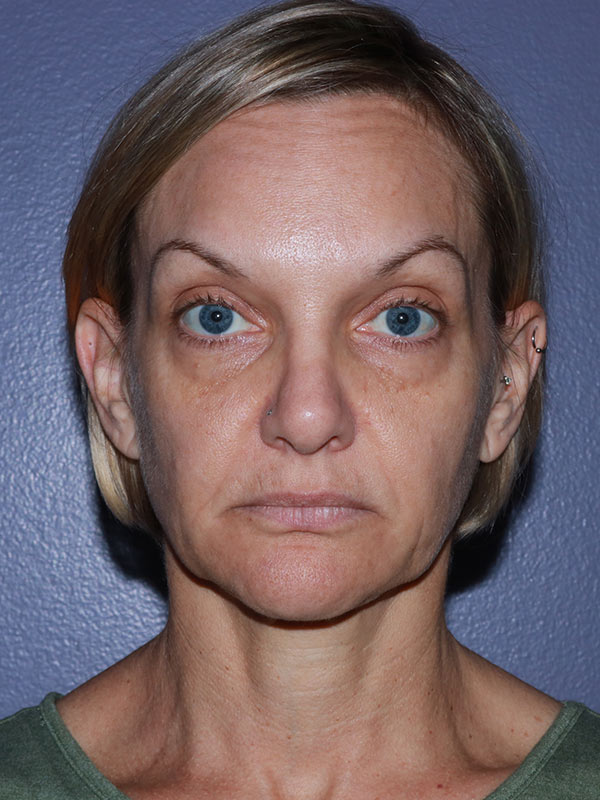 Neck Lift before photo
