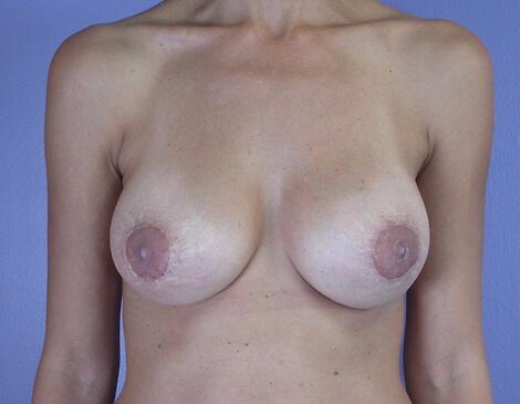 Mommy Makeover result at Marina Plastic Surgery