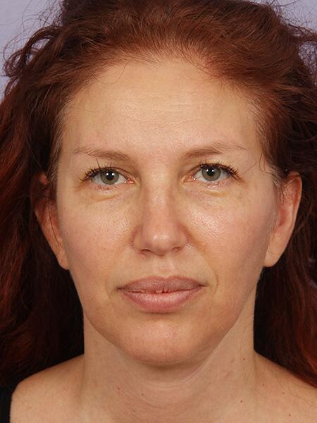 Facelift result at Marina Plastic Surgery