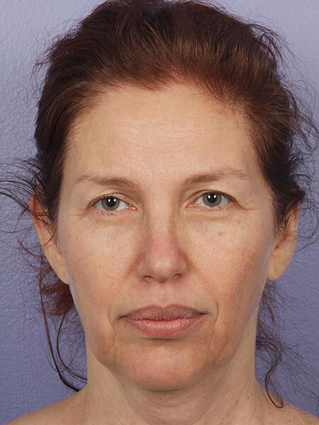 Facelift before photo