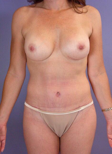 Mommy Makeover result at Marina Plastic Surgery