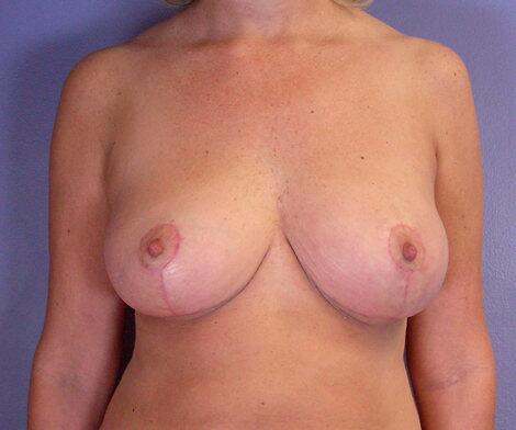 Breast Lift result at Marina Plastic Surgery