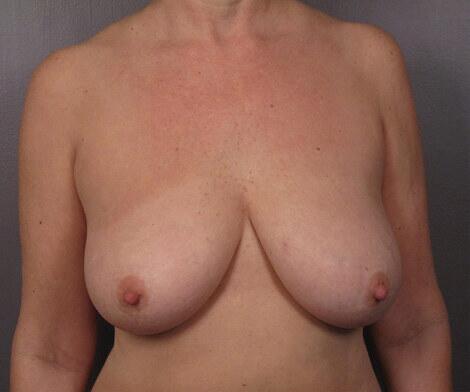 Breast Lift before photo
