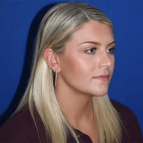 A result from PA Plastic Surgery Center - Dr Paul Warner Papillion