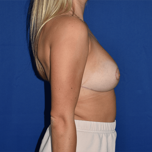 A result from PA Plastic Surgery Center - Dr Paul Warner Papillion