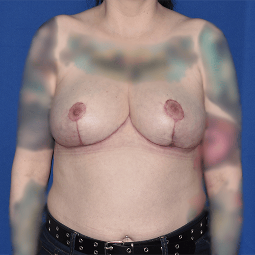 A result from PA Plastic Surgery Center - Dr Paul Warner Papillion