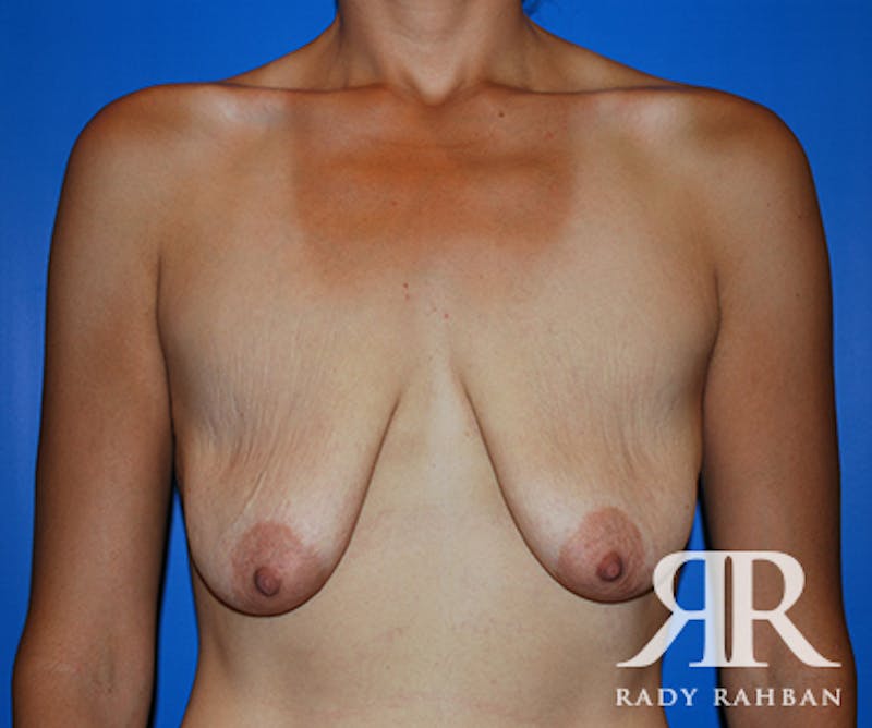 Breast Lift before photo