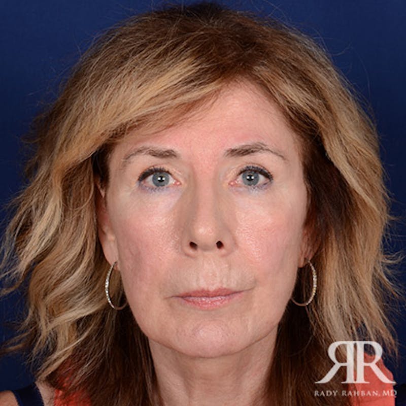 Facelift result at Dr. Rady Rahban
