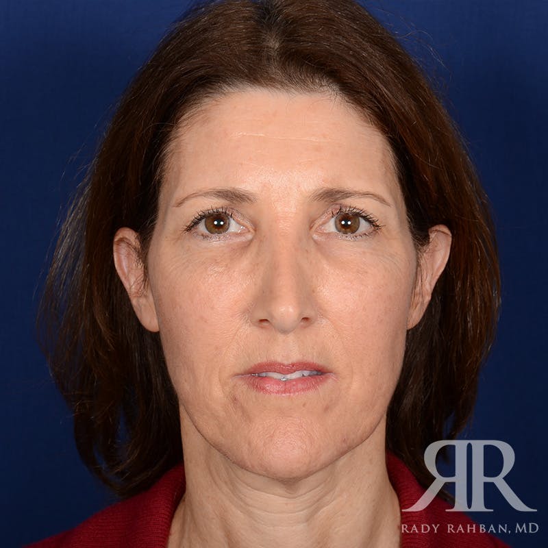 Facelift before photo