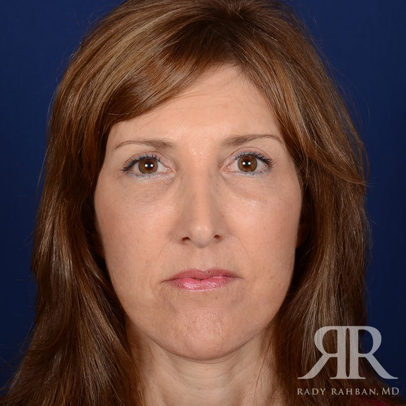 Facelift result at Dr. Rady Rahban