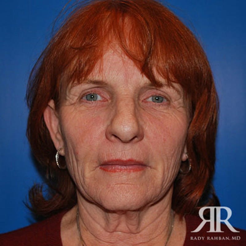 Facelift before photo
