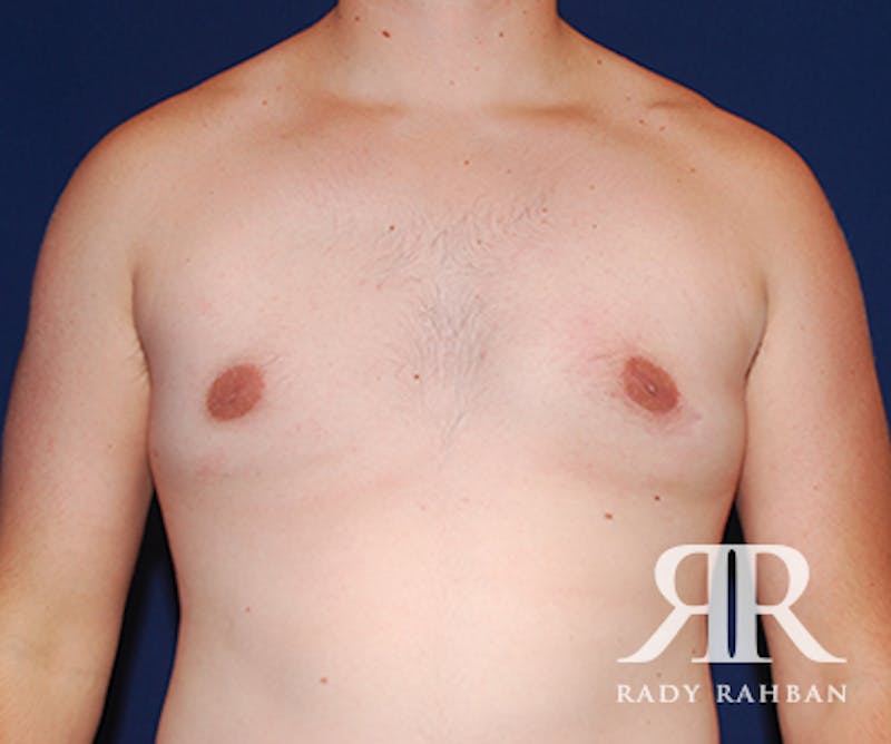 Gynecomastia result at Dr. Rady Rahban