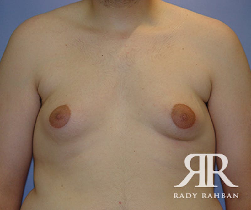 Gynecomastia before photo
