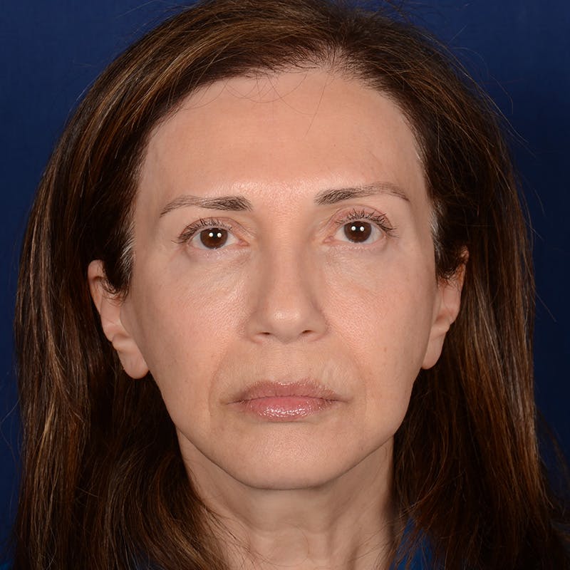 Facelift result at Dr. Rady Rahban