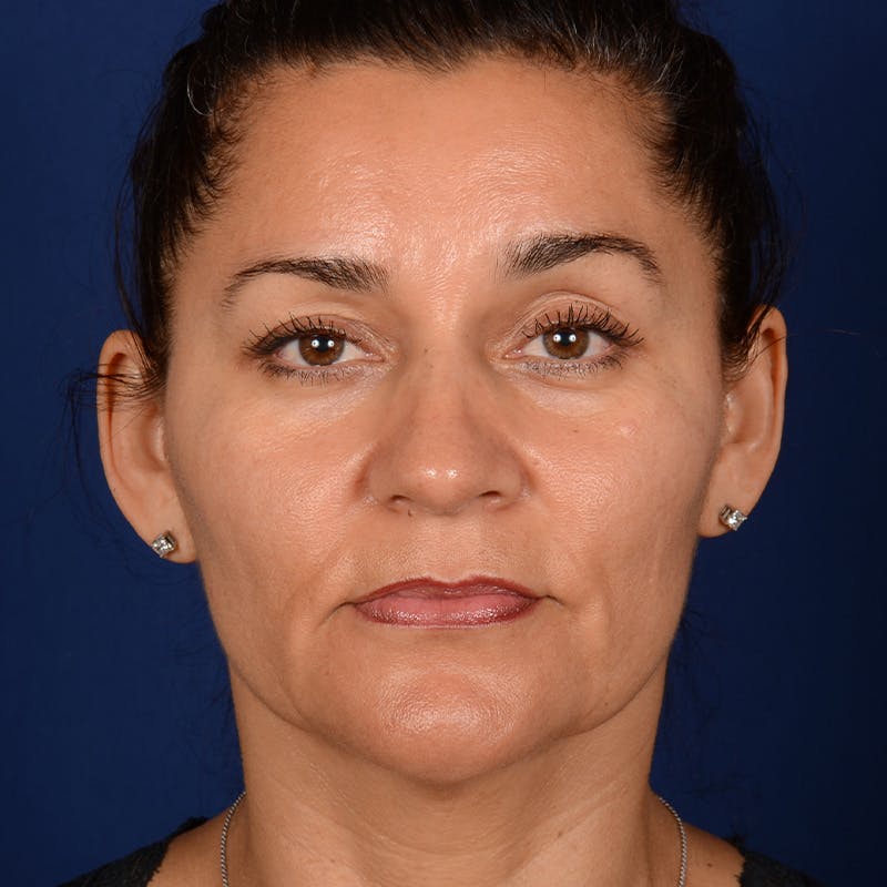 Facelift before photo