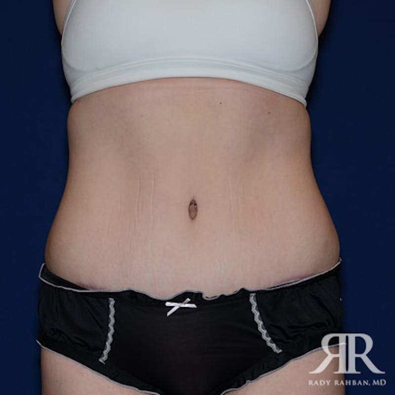 Tummy Tuck result at Dr. Rady Rahban
