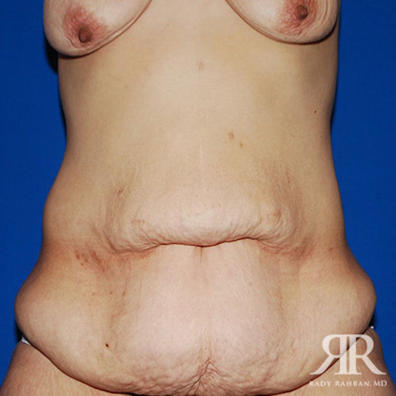 Tummy Tuck before photo