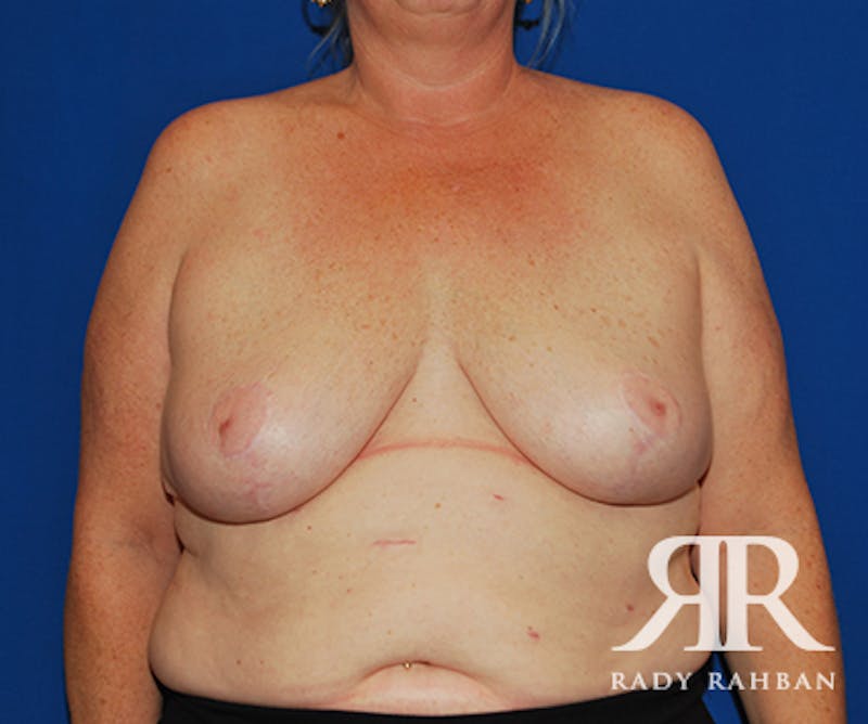 Breast Reduction result at Dr. Rady Rahban